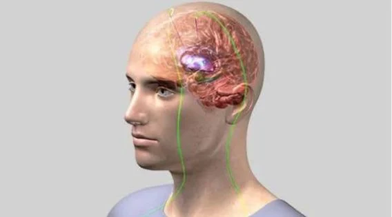Brain Pacemaker for Parkinsons’: Contact the Top DBS Surgeon in Kolkata, India