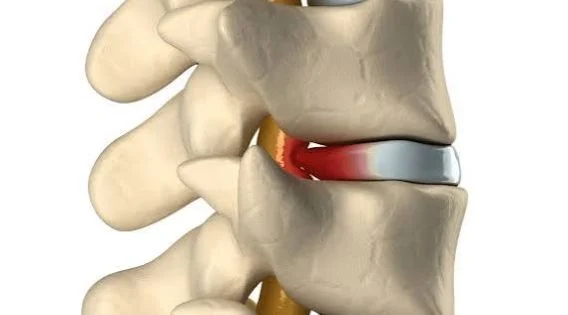 Consult a Top Neuro Spine Surgeon in Kolkata for Disc Replacement Surgery in India