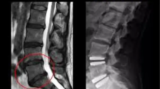 Disc Replacement India Consult the Best Cervical Spine Surgeon in India
